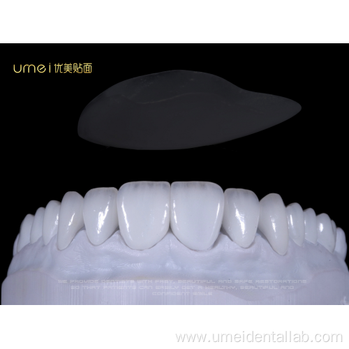 E.max layered veneers